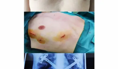 Operacija deformiteta grudnog ko&scaron;a