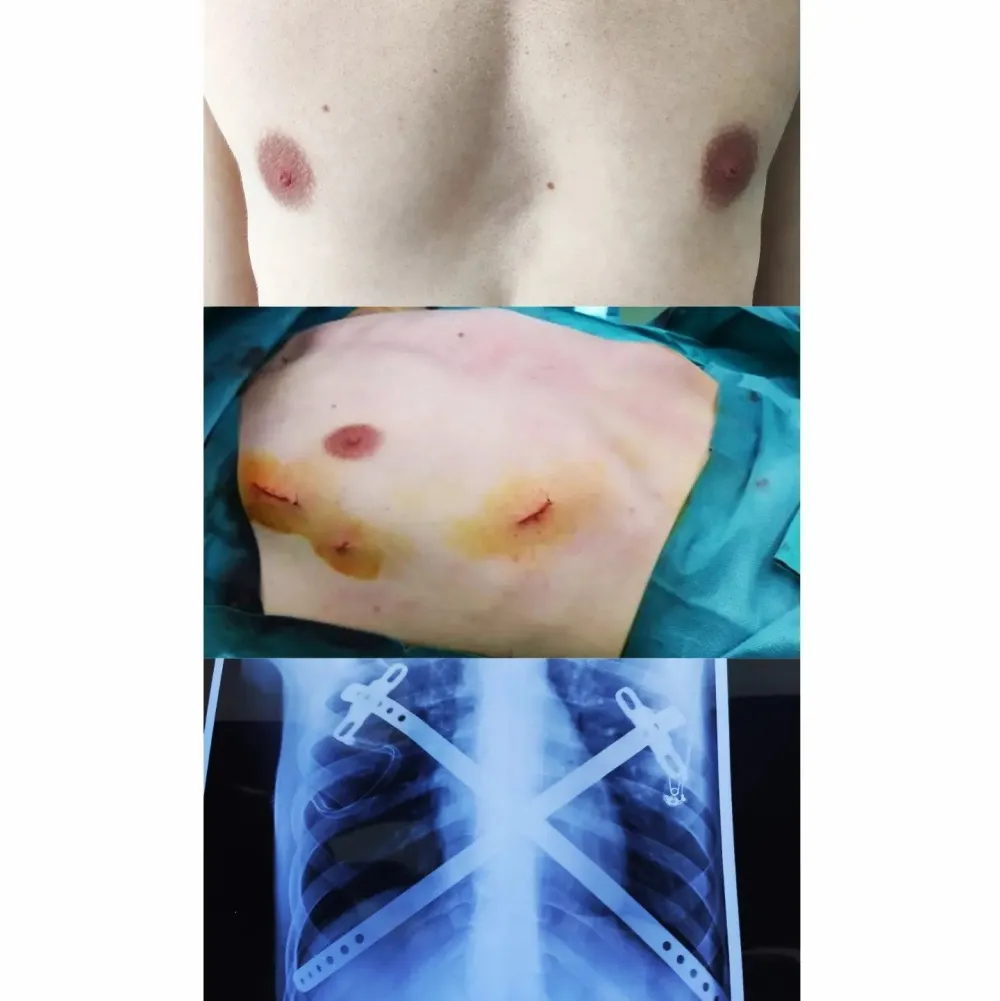Operacija deformiteta grudnog ko&scaron;a