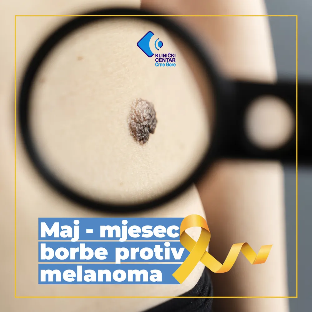 Maj &ndash; mjesec borbe protiv melanoma