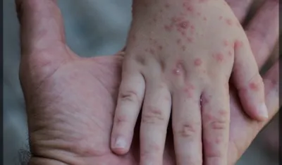 U Beogradu prijavljena epidemija malih boginja: Zaraženo 11 pacijenata