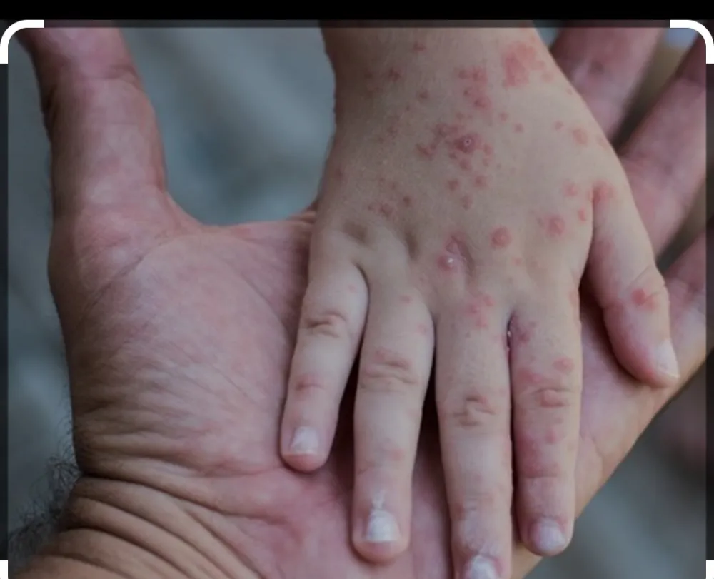 U Beogradu prijavljena epidemija malih boginja: Zaraženo 11 pacijenata