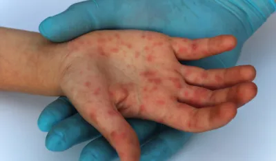 Progla&scaron;ena epidemija morbila u Banjaluci