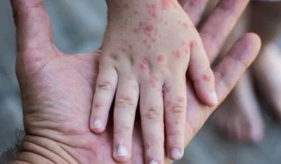 Epidemija morbila i u Podgorici, registrovana tri nova slučaja