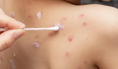 Vlada će Svjetskoj zdravstvenoj organizaciji (WHO) osigurati fleksibilna finansijska sredstva putem razn ih instrumenata za borbu protiv boginja i podržati svoje partnere u Africi putem GAVI saveza za vakcinaciju, dodao je portparol.  Njemačka ima oko 117.000 doza Jynneosa, koje njemačka vojska skladi&scaron;ti nakon &scaron;to ga je Berlin nabavio 2022. godine.  Zadržat će minimalnu količinu zaliha, kako bi se, na primjer, za&scaron;titile putujuće službe, kazao je portparol ministarstva odbrane u ponedjeljak. Trebalo bi donijeti posebnu odluku kada je riječ o ponovnom naručivanju vakcina, dodao je.  Svjetska zdravstvena organizacija proglasila je mpox globalnim vanrednim stanjem na polju javnog zdravstva nakon &scaron;to se epidemija u Demokratskoj Republici Kongo pro&scaron;irila na susjedne zemlje, a novi oblik virusa, klade Ib, izazvao je zabrinutost oko brzine prenosa.  Vlada je tražila najbrži način da dopremi vakcine u pogođene zemlje, prvenstveno u Demokratsku Republiku Kongo, ali i Burundi i susjedne zemlje u istočnoj Africi, saopćio je portparol ministarstva vanjskih poslova, prenosi Reuters.