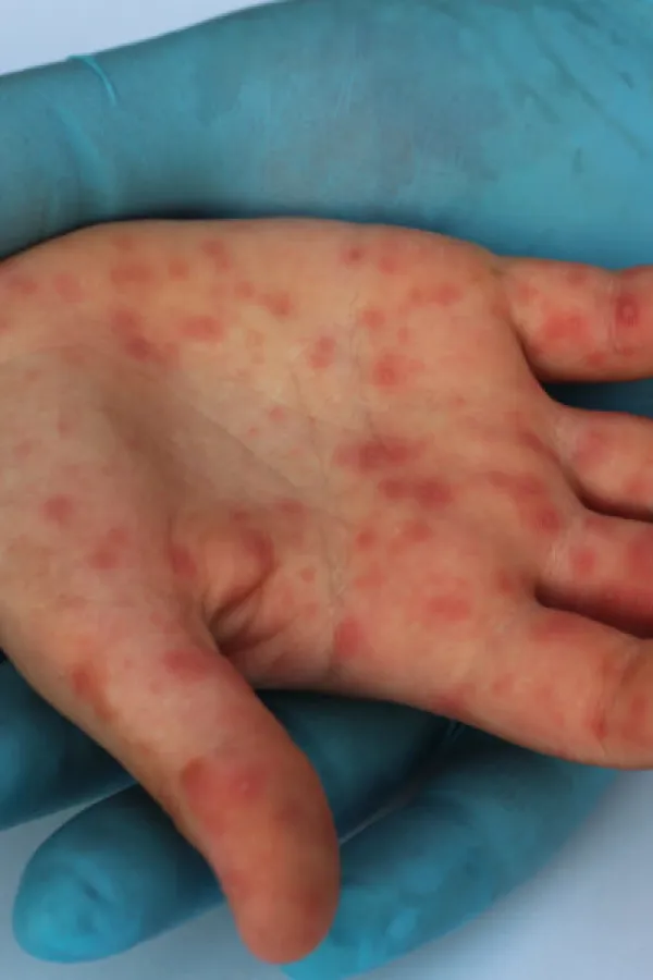 Iz IJZ-a upozoravaju na rizik od &scaron;irenja morbila: Prijeti velika epidemija, nevakcinisano 29.000 djece