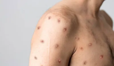 SZO odobrila prvu vakcinu protiv majmunskih boginja