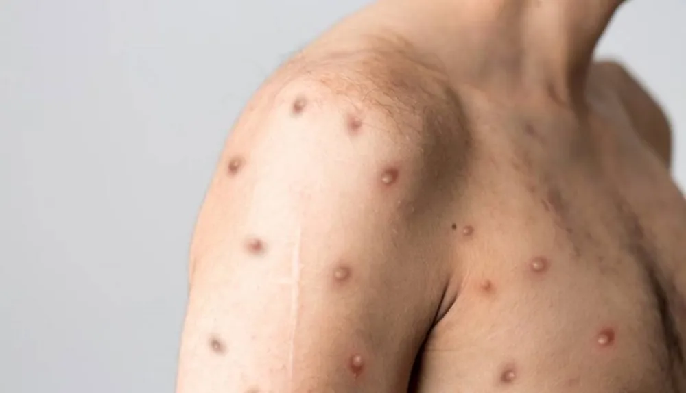 SZO odobrila prvu vakcinu protiv majmunskih boginja