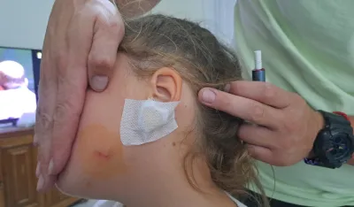 (FOTO) Nik&scaron;ić: Čopor pasa lutalica napao i ugrizao za lice &scaron;estogodi&scaron;nje dijete