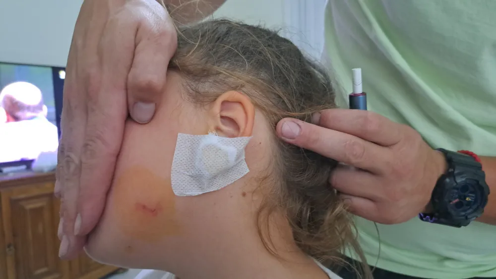 (FOTO) Nik&scaron;ić: Čopor pasa lutalica napao i ugrizao za lice &scaron;estogodi&scaron;nje dijete