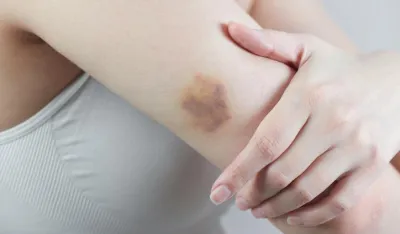 Modrice pri najmanjem dodiru: Za&scaron;to se pojavljuju i kada je vrijeme za paniku?