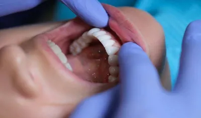 Pet stvari koje va&scaron;i zubi mogu otkriti o va&scaron;em zdravlju