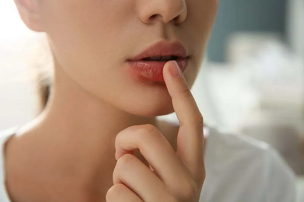 Kako se rije&scaron;iti herpesa prirodnim putem: Isprobajte ove jednostavne metode