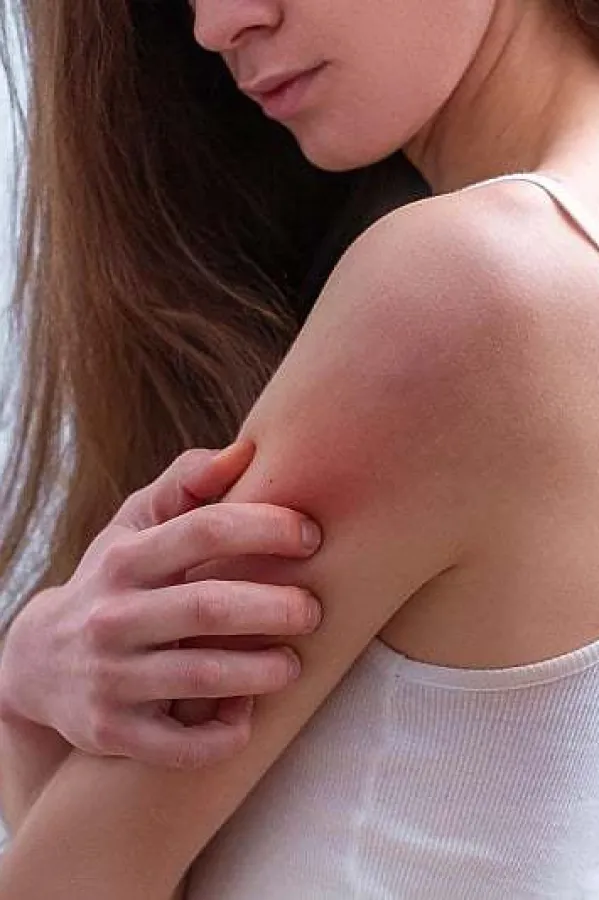 Kako prepoznati rane znakove psorijaze i kontrolisati je na vrijeme