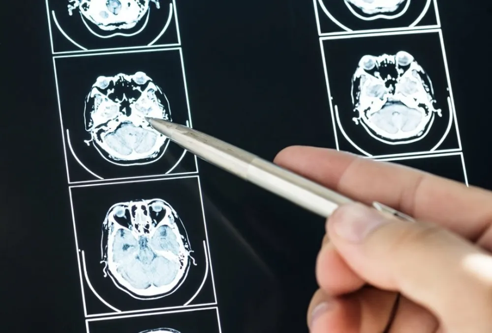 Simptomi aneurizme koje ne treba ingorisati