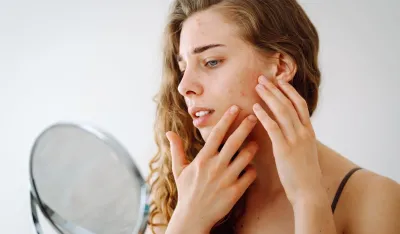 Da li mliječni proizvodi izazivaju akne?