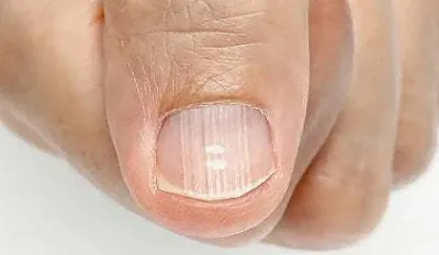 Vertikalni nabori na noktima: Uobičajena pojava ili znak zdravstvenih problema?