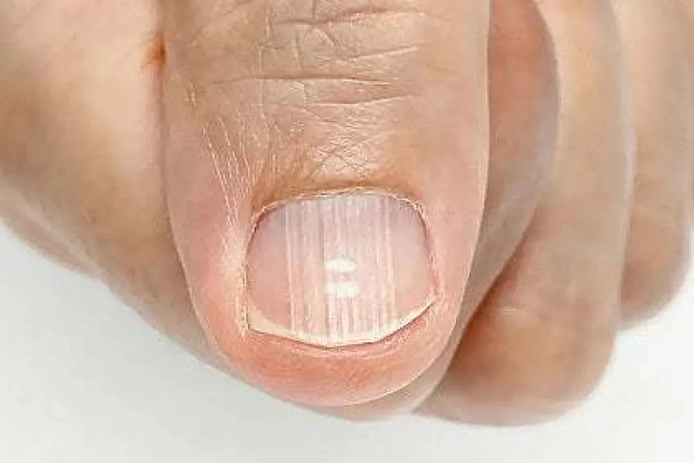 Vertikalni nabori na noktima: Uobičajena pojava ili znak zdravstvenih problema?