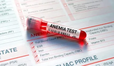 Manje poznati simptomi koji ukazuju na anemiju