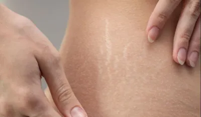 Da li vazelin elimini&scaron;e strije?