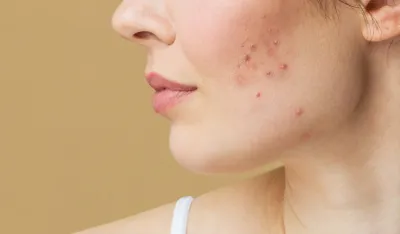 Simptomi visokog &scaron;ećera u krvi koje možete primijetiti i na va&scaron;em licu