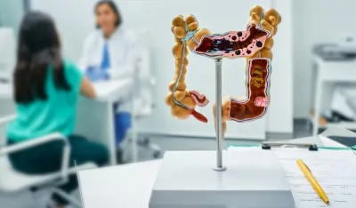 Mesne prerađevine mogu da izazovu rak debelog crijeva