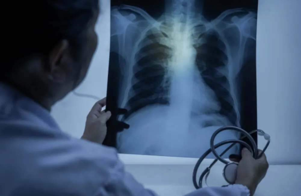 Vje&scaron;tačka inteligencija može da otkrije rak pluća mjesecima ranije &ndash; nova nada za rano liječenje