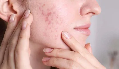 Gljivične akne: Kako ih razlikovati od običnih i liječiti prirodnim metodama