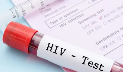 Istraživači u Belgiji razvili metod koji bi virus HIV mogao da učini trajno bezopasnim