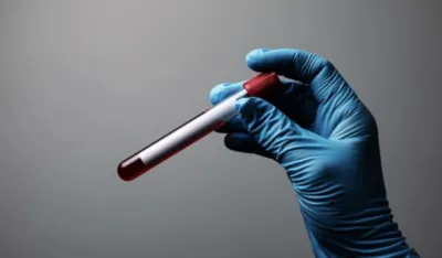 Dijagnostikovanje Alchajmerove bolesti uskoro na osnovu analize krvi