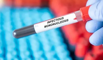 Mononukleoza može uzrokovati multipla sklerozu