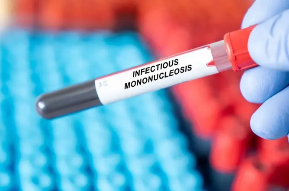 Mononukleoza može uzrokovati multipla sklerozu