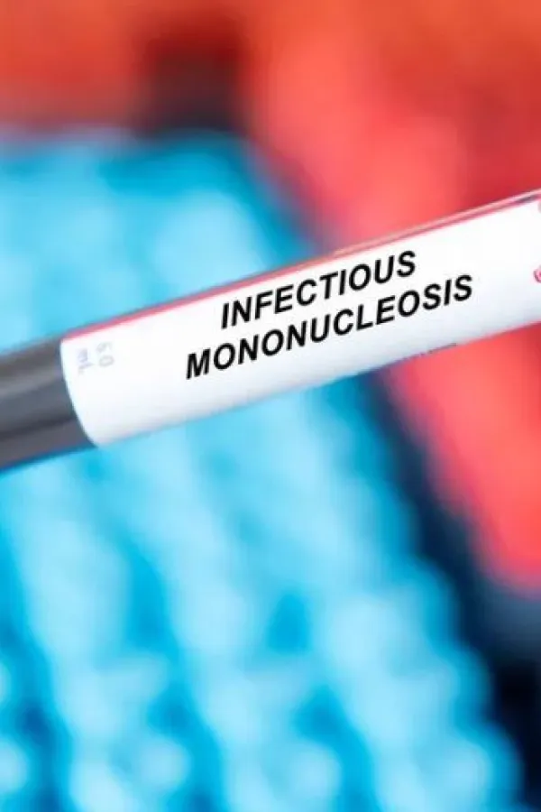 Mononukleoza može uzrokovati multipla sklerozu