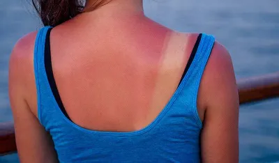 Kako ublažiti opekotine od sunca