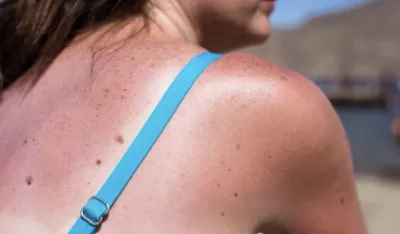 Ovo nikako ne radite ako imate alergiju na sunce