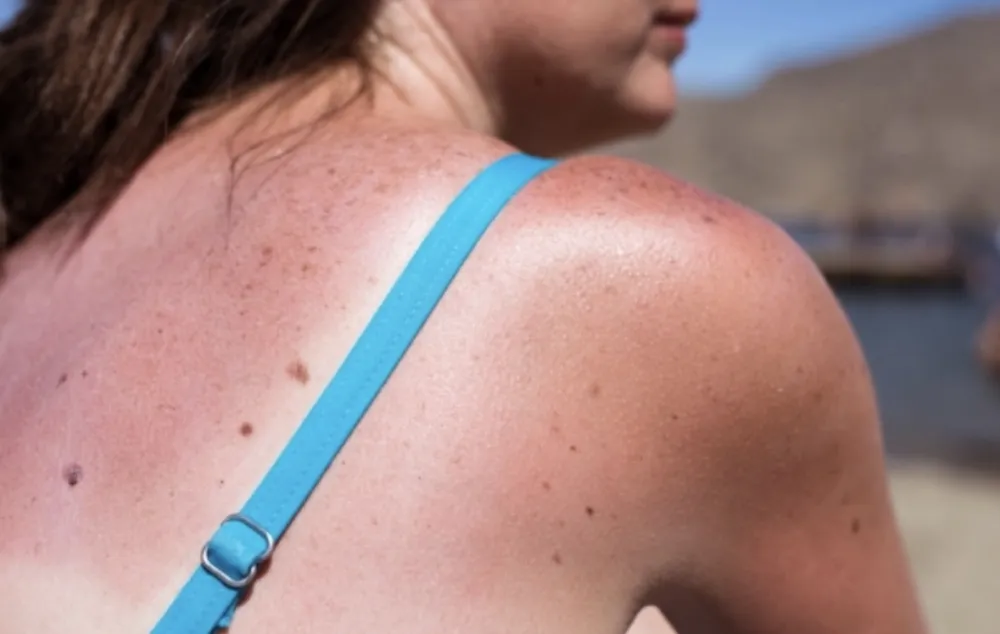 Ovo nikako ne radite ako imate alergiju na sunce