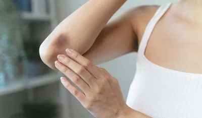 Neobja&scaron;njive modrice mogle bi biti znak raka krvi