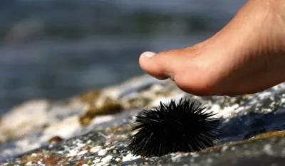 Ubod morskog ježa može da dovede do prestanka disanja