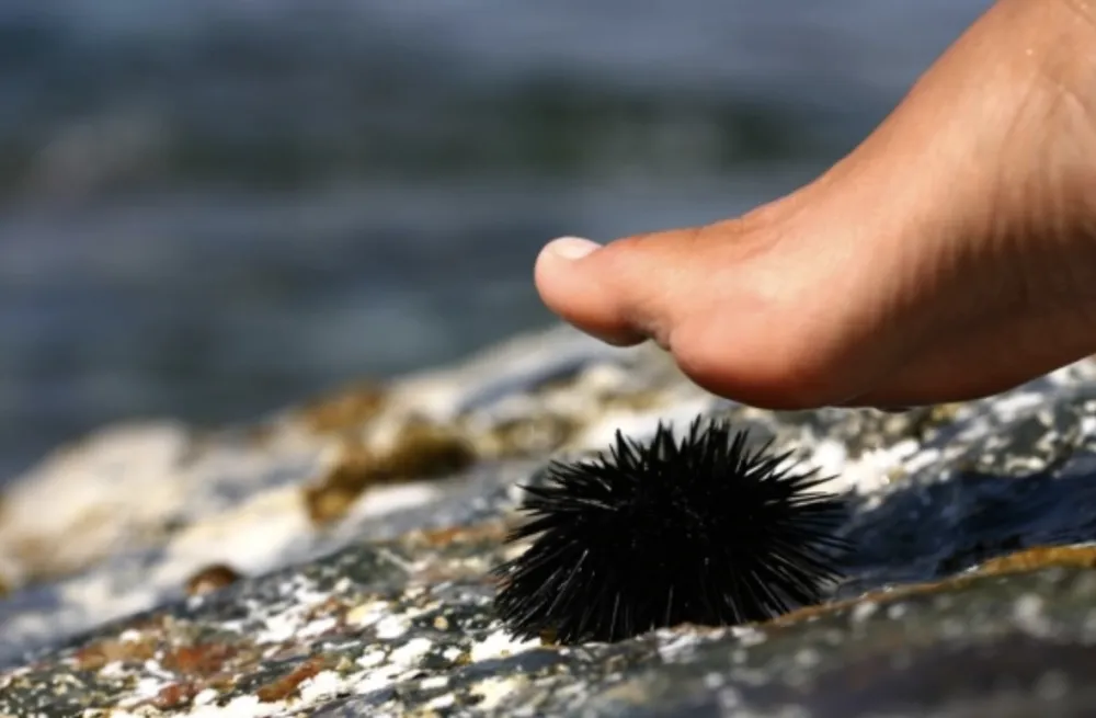 Ubod morskog ježa može da dovede do prestanka disanja
