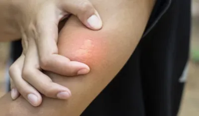 Ubod ose može da bude smrtonosan: Evo kako da na vrijeme prepoznate reakciju