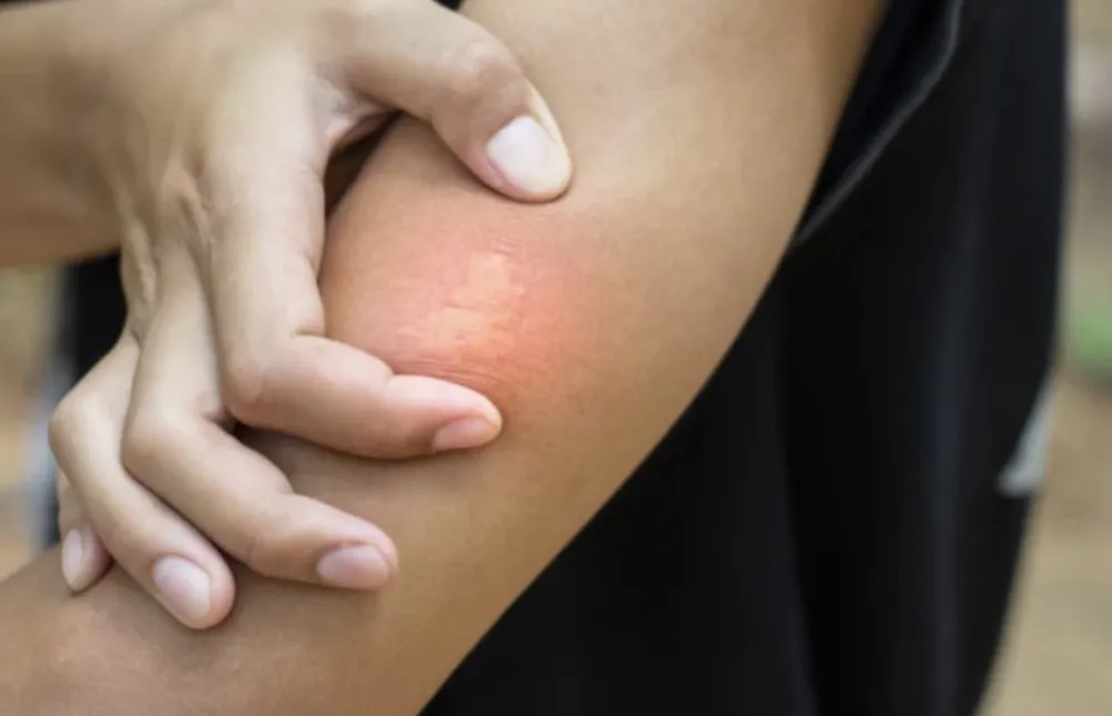 Ubod ose može da bude smrtonosan: Evo kako da na vrijeme prepoznate reakciju