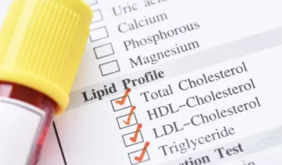 Ova tri znaka mogu da ukazuju da imate opasno visok holesterol