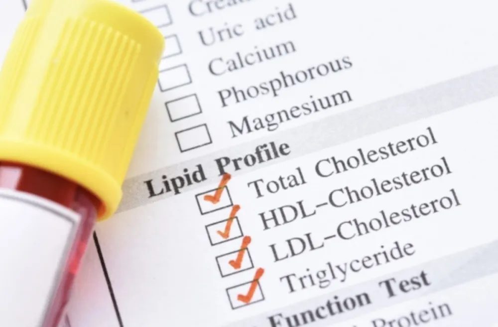 Ova tri znaka mogu da ukazuju da imate opasno visok holesterol