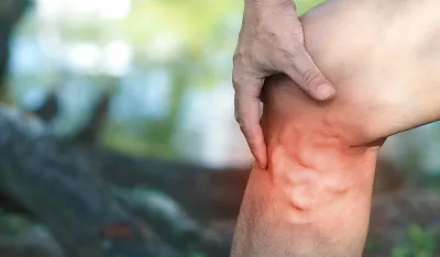 Ovi simptomi mogu biti znak da se u tijelu stvara tromb