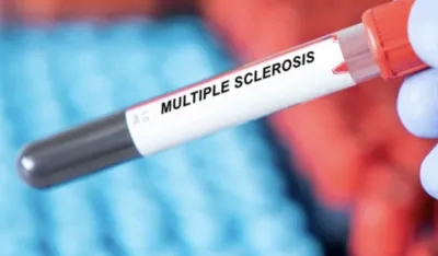 Ovi simptomi mogu da ukazuju na multiplu sklerozu: Javljaju se i 15 godina prije dijagnoze