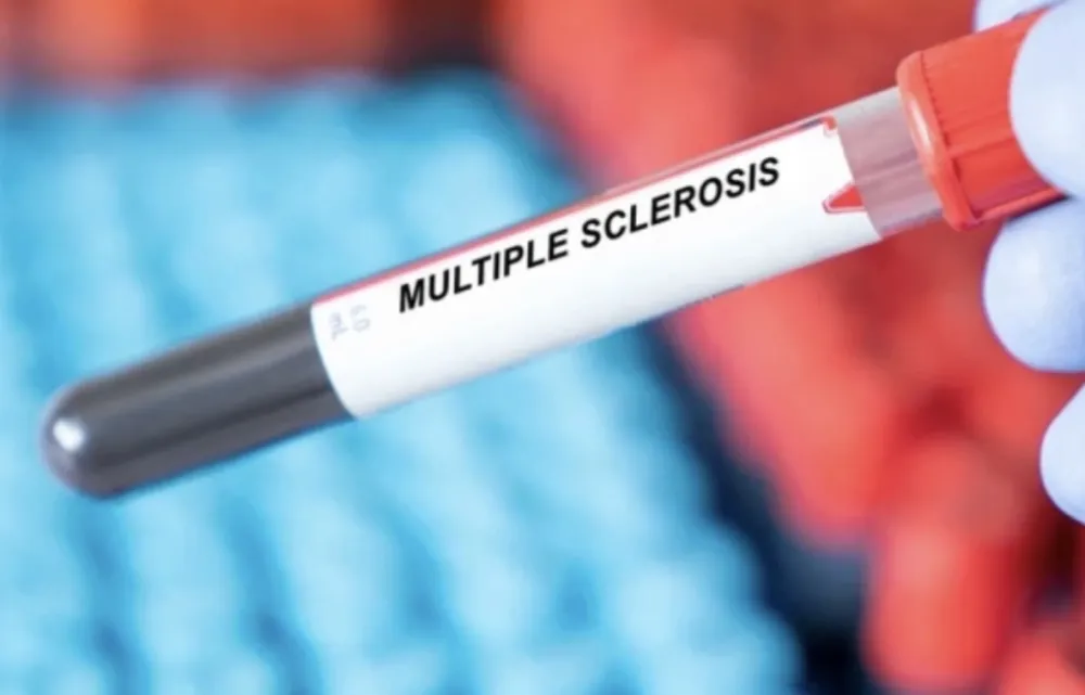 Ovi simptomi mogu da ukazuju na multiplu sklerozu: Javljaju se i 15 godina prije dijagnoze