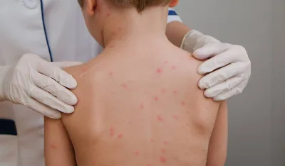 Drastičan rast slučajeva varičele u poslednjih devet godina: Broj oboljelih od ovčijih boginja porastao na skoro 5.500