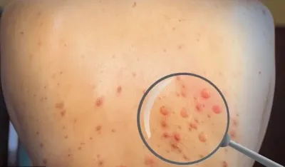 Senegal prijavio prvi slučaj majmunskih boginja ove godine