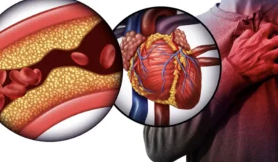 Nutricionisti otkrivaju: Ovo je pet zabluda o holesterolu