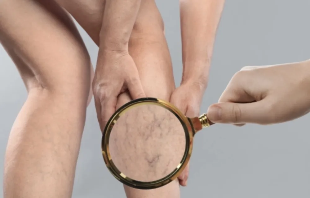 Bolesti vena sve če&scaron;će: Svakodnevne navike mogu da ubrzaju tok bolesti