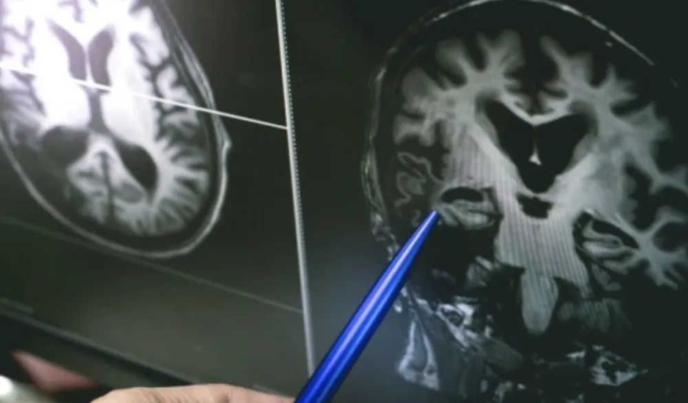 Matične ćelije bi mogle da oporave mozak posle &scaron;loga